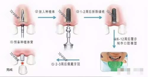 种植牙的6个步骤图解.jpg