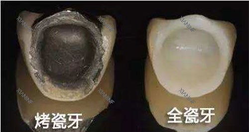 烤瓷牙和全瓷牙展示图.jpg