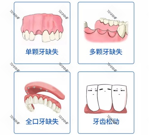 单颗多颗全口牙齿缺失及牙齿松动漫画图.jpg