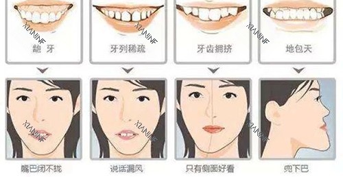 牙齿矫正脸型变化适应症.jpg