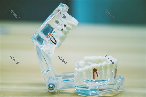 根管治疗牙齿模型.jpg