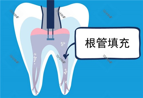 根管填充图示.jpg