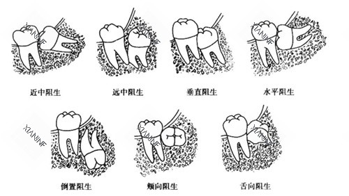 智齿各种阻生示意图.jpg