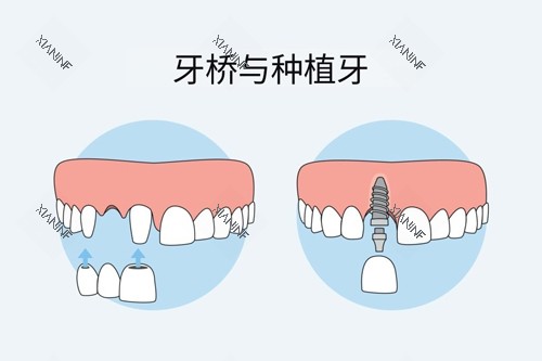 牙冠桥和种植牙对比图.jpg
