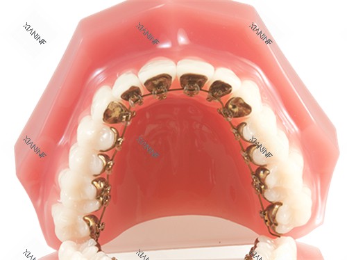 牙齿矫正金属舌侧矫正牙套模型.jpg